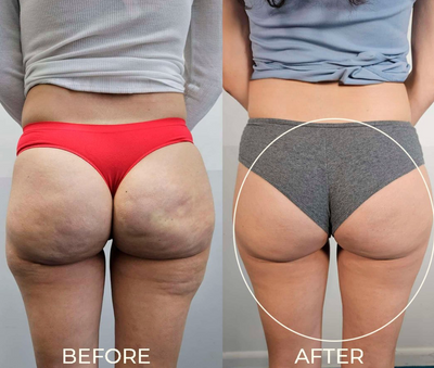 Anti Cellulite Gel